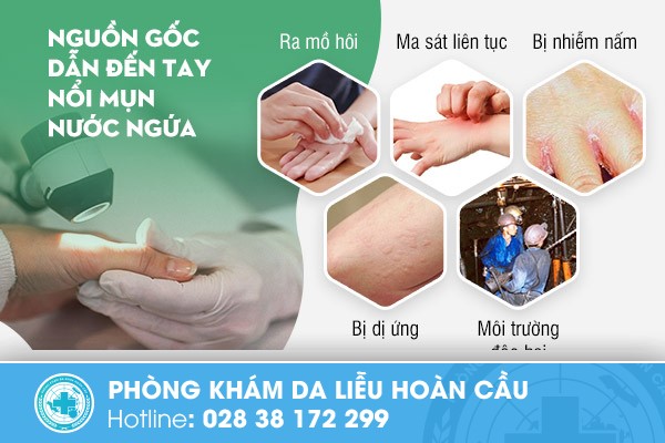 Các căn nguyên khiến tay nổi mụn nước